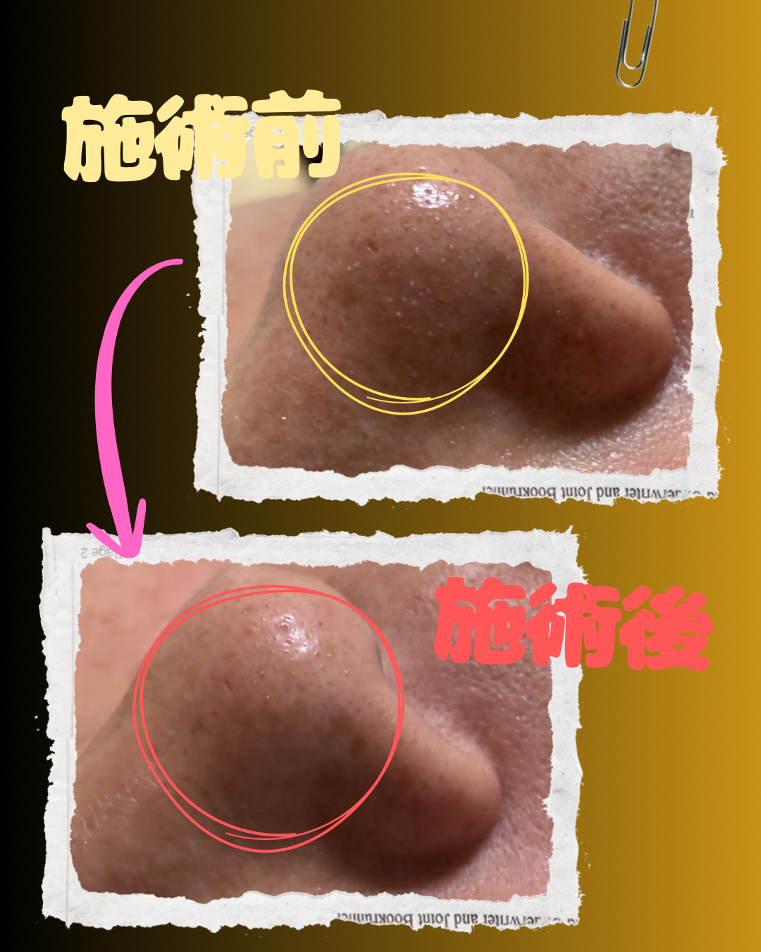 毛穴洗浄　（40代男性）