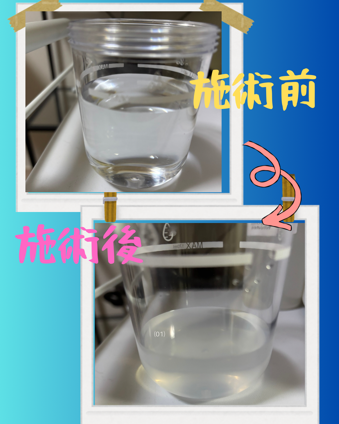 毛穴洗浄　汚れ具合の比較です